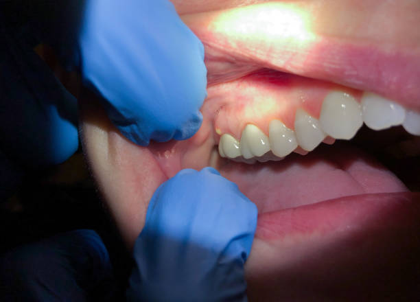 Best Emergency Root Canal Treatment in Passapatanzy, VA